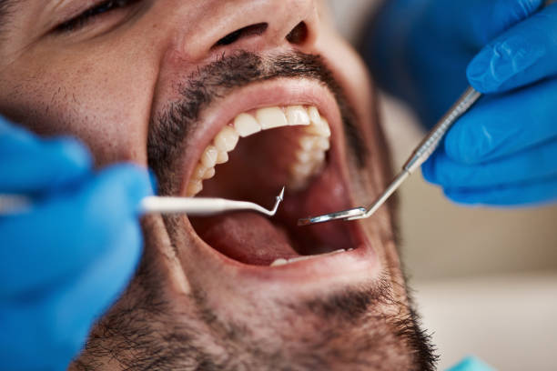 Best Emergency Wisdom Teeth Removal in Cohoe, AK